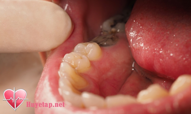 3. Điều trị sâu răng ngăn ngừa đột quỵ 1