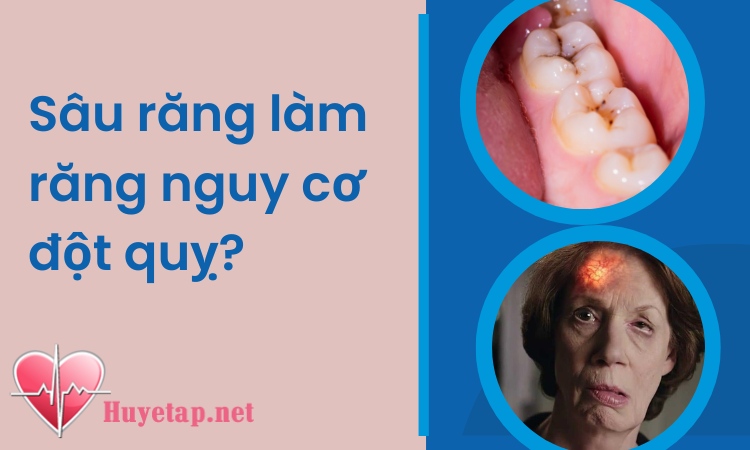 Có phải sâu răng làm tăng nguy cơ đột quỵ không? 1